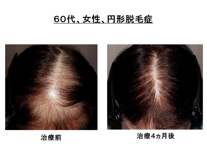 円形脱毛症　病